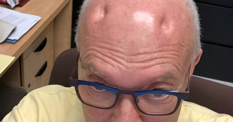 man had 4 dents appear in his head