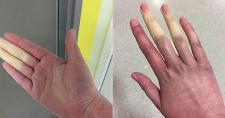 Rare Disorder Can Turn Fingers, Toes White or Blue When it’s Cold - Featured image