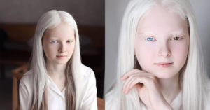 Ethereal Portraits Highlight the Unique Beauty of a Girl With Albinism and Heterochromia albino girl