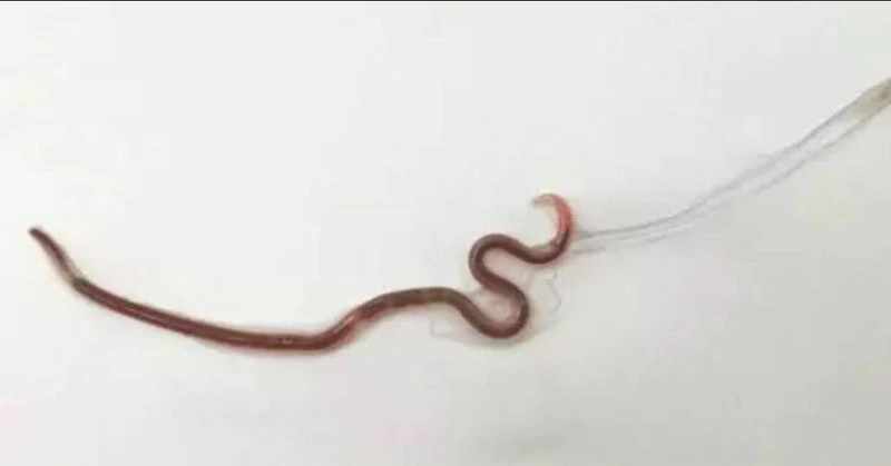 Doctors pull 1.5-inch worm from woman’s tonsils after she ate sashimi - Featured image