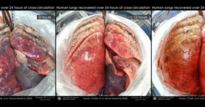 damaged human lungs