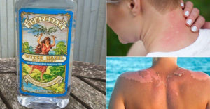 witch hazel sun burn relief