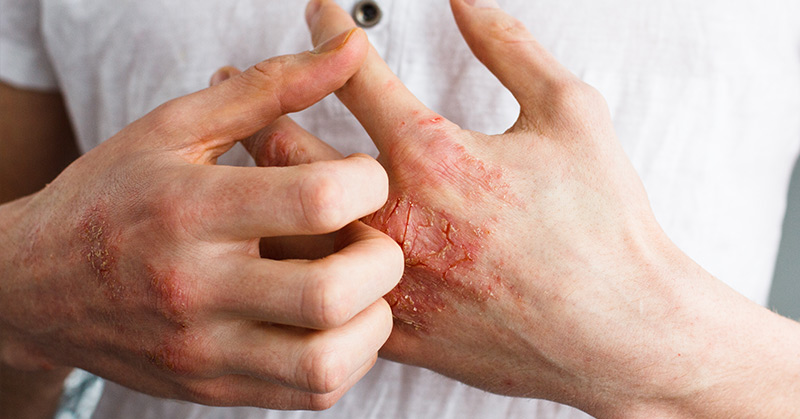 Scientists Are Figuring Out What Happens in The Skin When You Have Eczema - Featured image