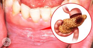 RF_June22_10_Can-gum-disease-be-fatal-798x418