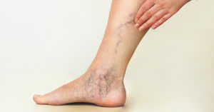 varicose veins