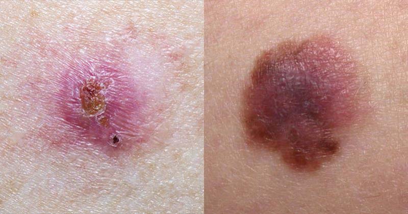 These Close-Up Images Show Exactly What Different Types of Skin Cancer Look Like - Featured image