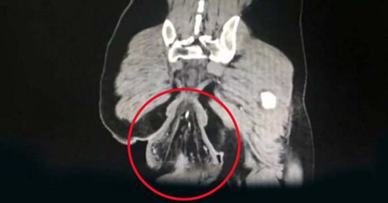 Man Suffers Rectal Prolapse After Playing Phone Games On Toilet - Featured image