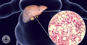 fattyliver