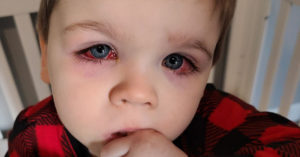 Boy Comes Dangerously Close To Losing Vision After Playing With Bath Toys, Mother Warns child with red eyes