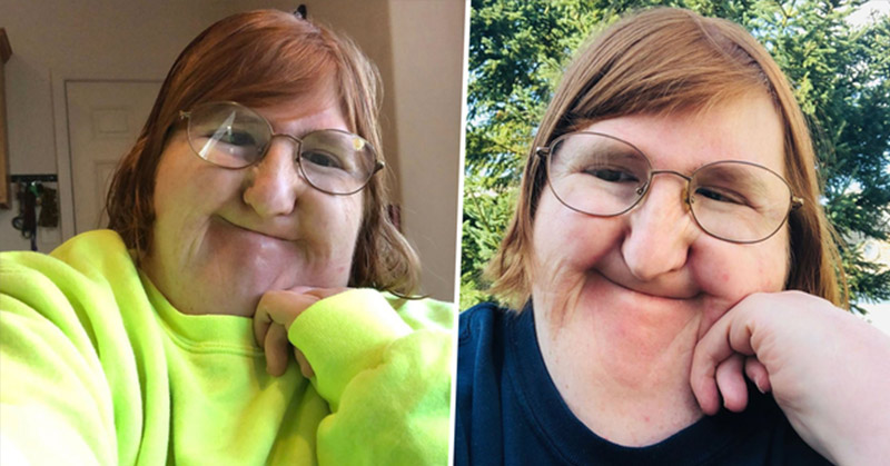 Woman With Bone Disorder Shares Selfie Everyday For a Year - Featured image