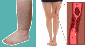 6 Warnings Your Body May Give When a Blood Clot Forms blood clot warnings