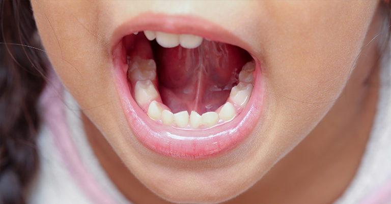 ‘Rapid evolution’ means humans now being born without wisdom teeth - Featured image