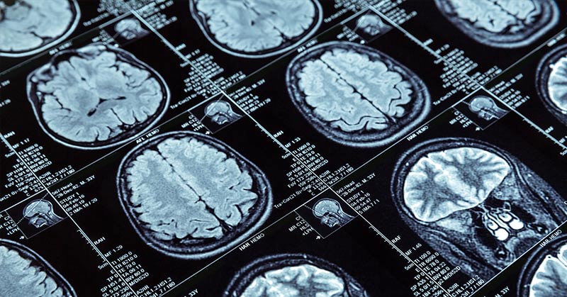 MS treatment a step closer after drug shown to repair nerve coating - Featured image