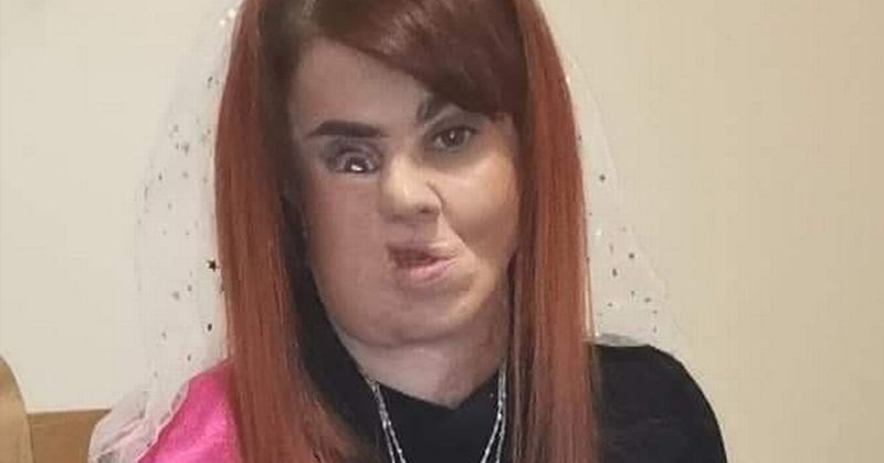 Woman who lost parts of face to flesh-eating bug left feeling like ‘freak show’ - Featured image