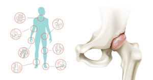 10 Home Remedies for Joint Pain and Arthritis home remedies arthritis