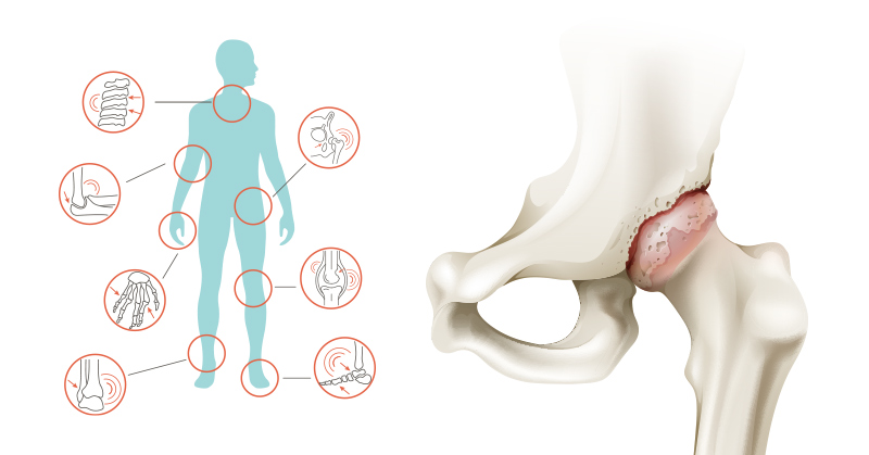 10 Home Remedies for Joint Pain and Arthritis - Featured image