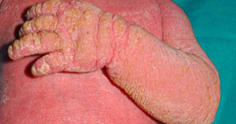 Baby Suffering From Incurable Rare Skin Disorder Receives Life Changing Treatment - Featured image