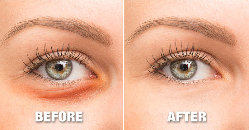 Why we get dark circles and how to get rid of them - Featured image