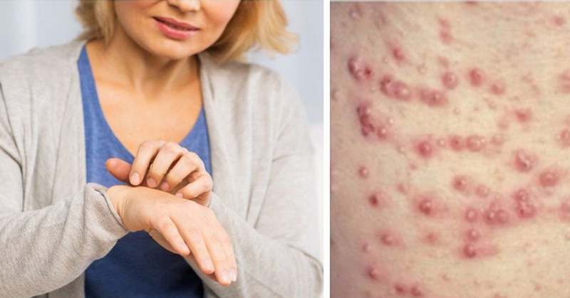 Eruptive Xanthomatosis Is A Skin Condition No One Should Ignore - Featured image