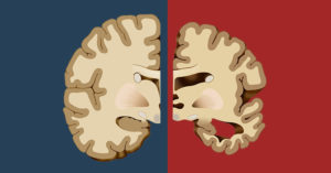 Before Dementia Sets in, Your Body Will Give You These 12 Early Warning Signs dementia concept, illustration of brain with one side of it afflicated with dementia (shrunken) and the other of a healthy brain.
