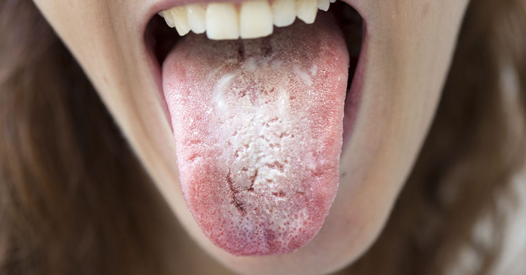 What is Candida Overgrowth, and Do You Have It? - Featured image