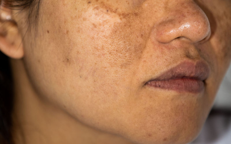 gros plan de l’hyperpigmentation sur une femme