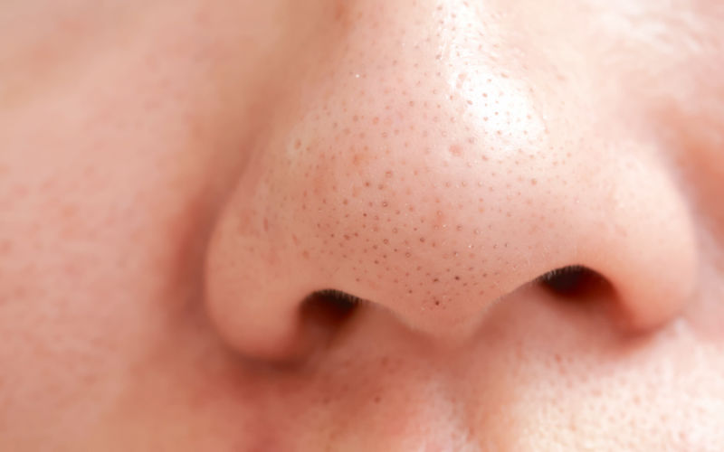 nose with blackheads