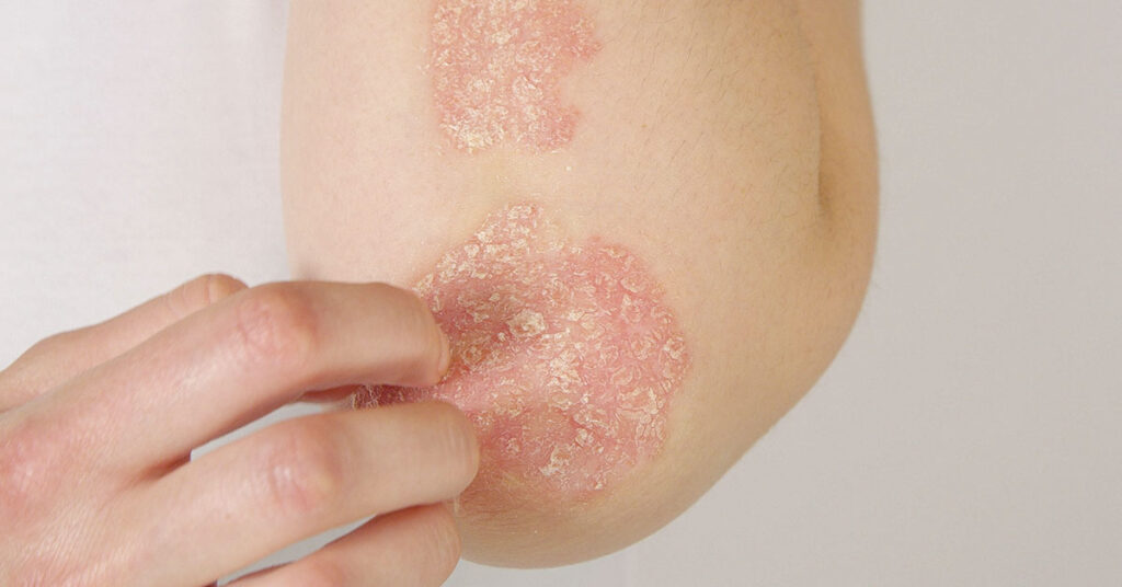 Woman Clears Psoriasis Covering 90% Of Body After Claiming She “Discovered Root Cause” - Featured image