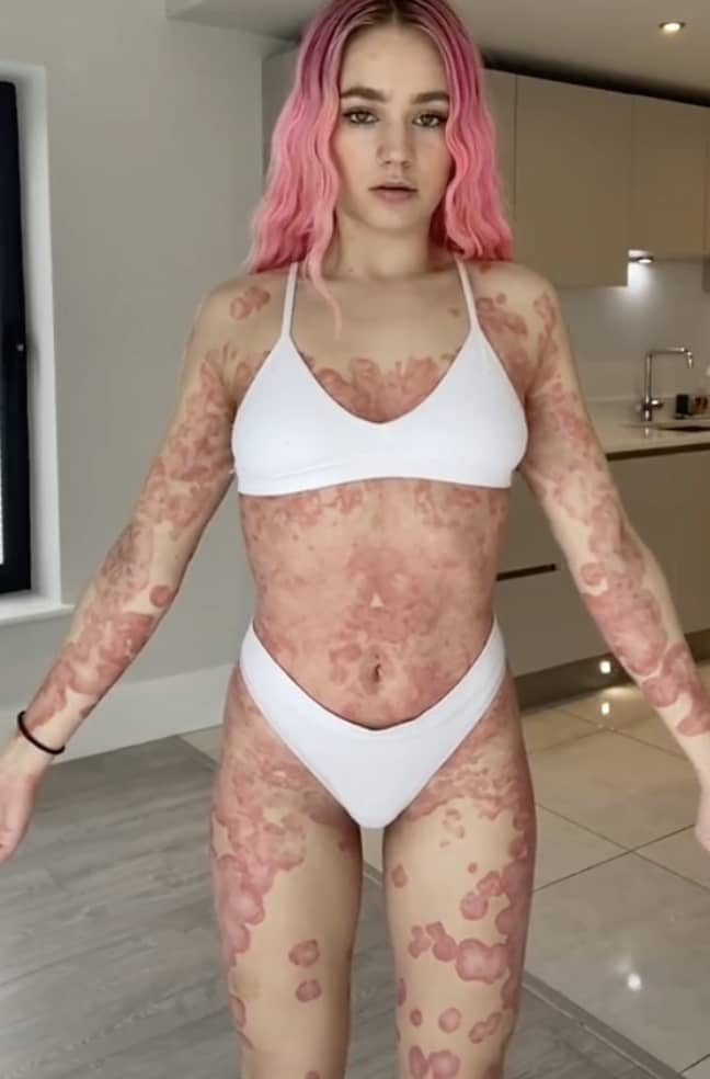 woman with psoriasis covering most of her body