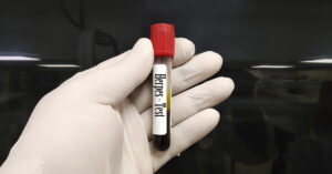 'I Thought I Had A Headache. It Turned Out To Be Herpes (HSV-1) — In My Brain.' gloved hand holding vile with "herpes test" printed on it