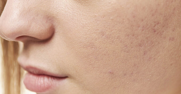 8 Vitamin Deficiencies That Show Up On Your Skin - Featured image