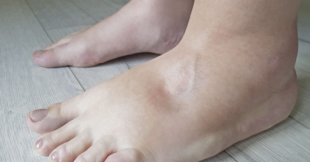 She hid a golfball sized lump from boyfriend for years. Showing him