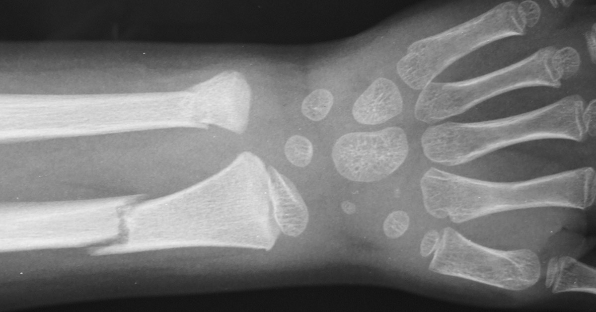 x ray of arm