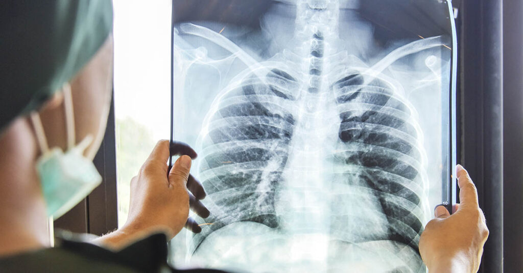 10 Warning Signs of Lung Cancer - Featured image