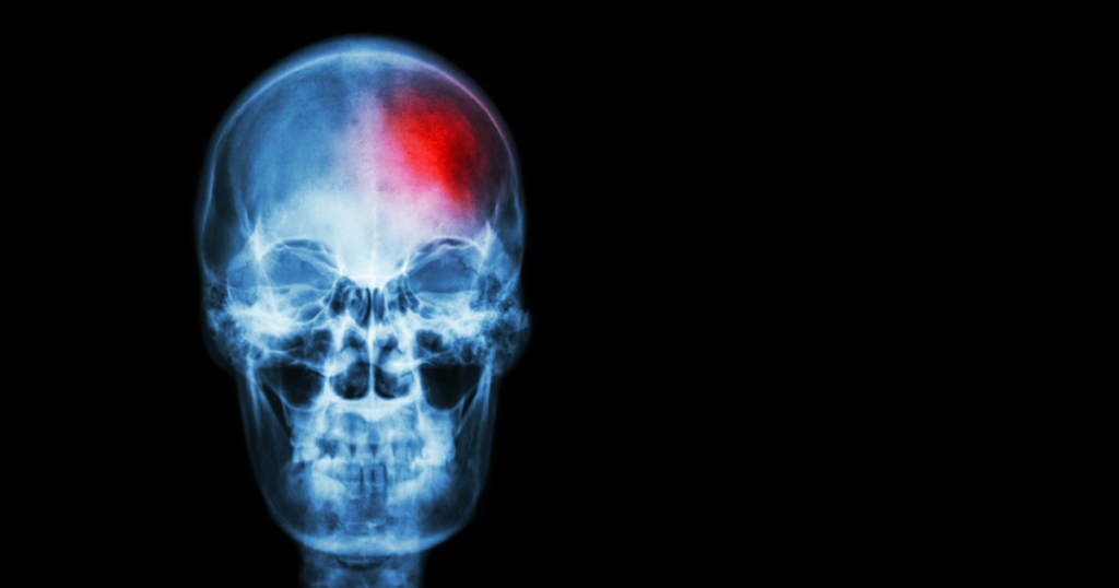 Half of Stroke Patients Notice These Warning Signs a Week Before—Are You at Risk? - Featured image