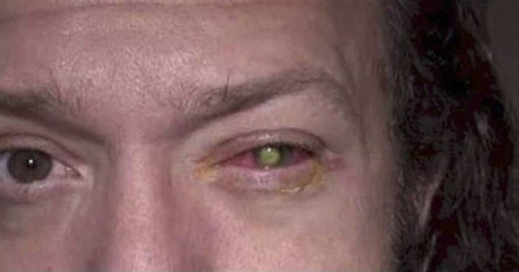 eye infected with pseudomonas