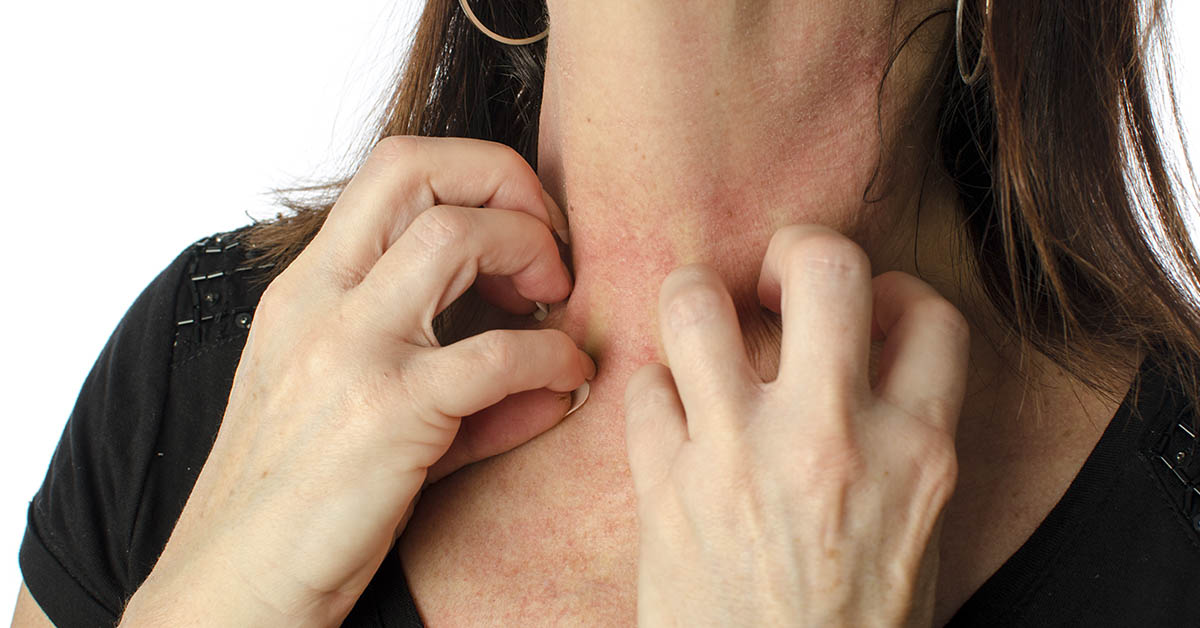 woman with allergic reaction scratching her neck area