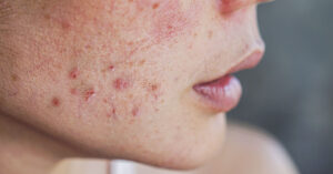 Do Vitamin B12 Supplements Cause Acne, Bone Fractures, and Lung Cancer? face with acne