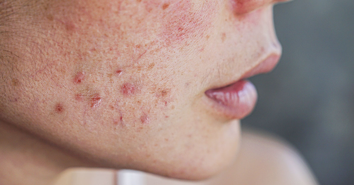 face with acne