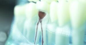 Fact Check: Are root canals dangerous, and do they increase your risk of chronic disease? illustration of root canal