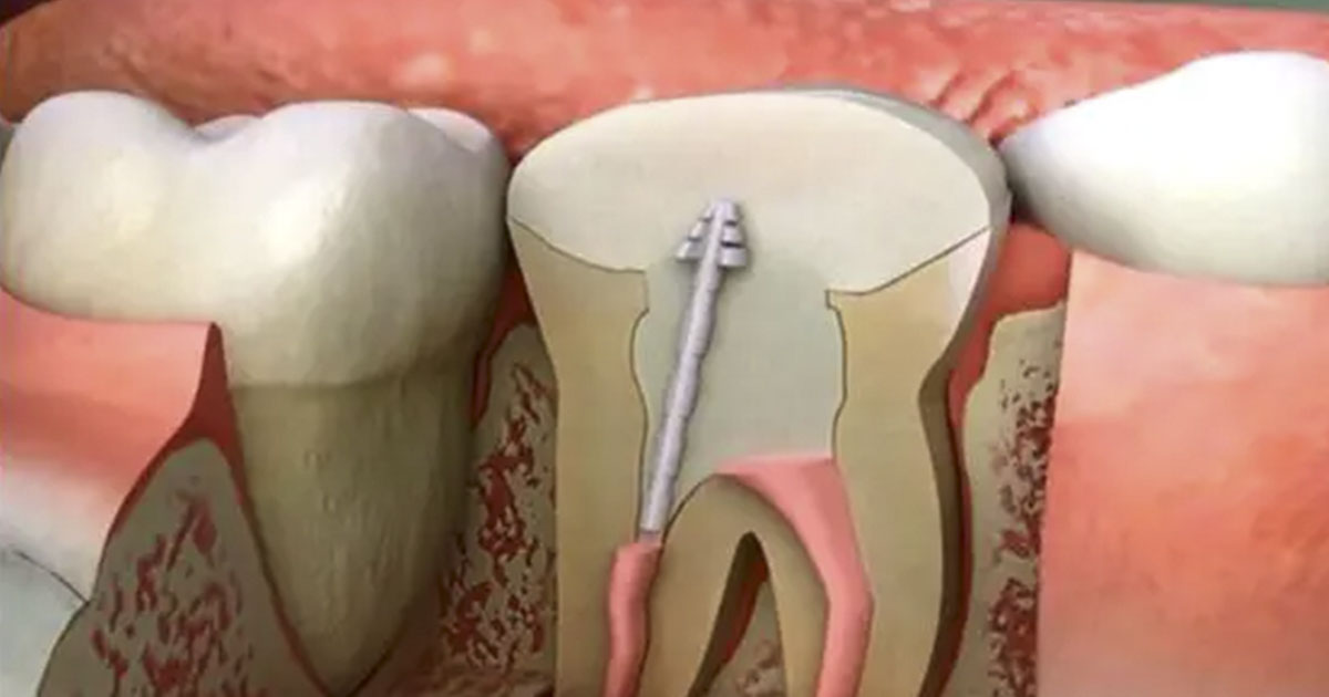 Fact Check Are root canals dangerous? The Hearty Soul