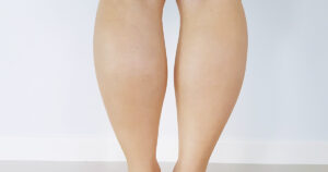 legs displaying water retention