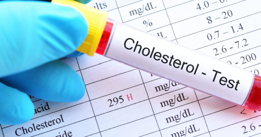 Blood sample tube with abnormal high cholesterol test result
