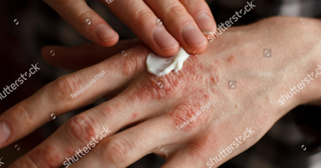 applying oregano oil cream to skin infection on hand