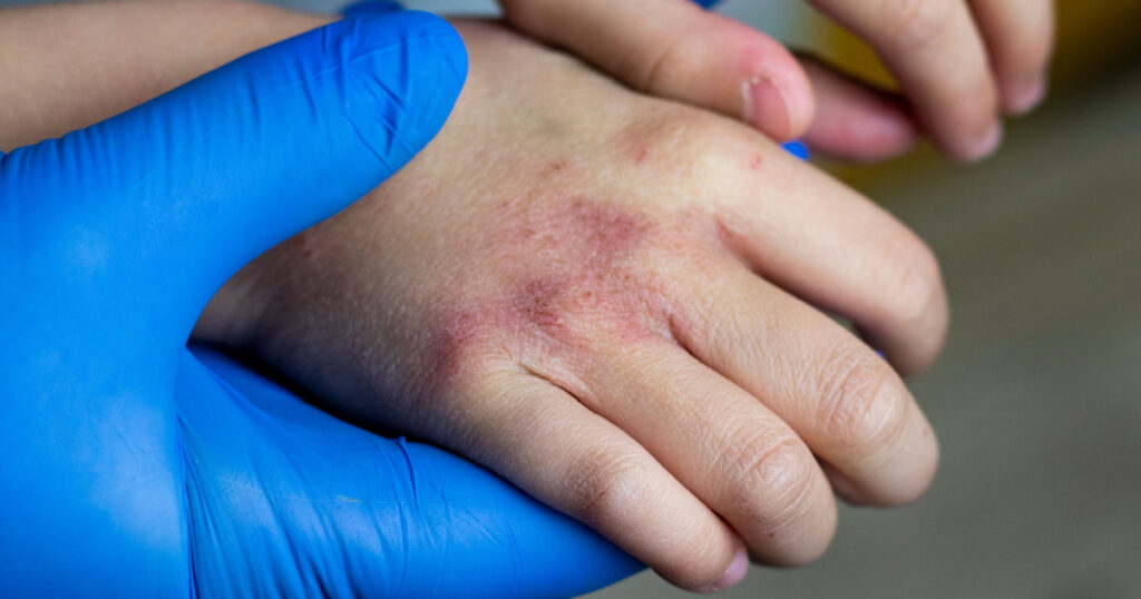 blue gloved hands holding childs hands with skin issue