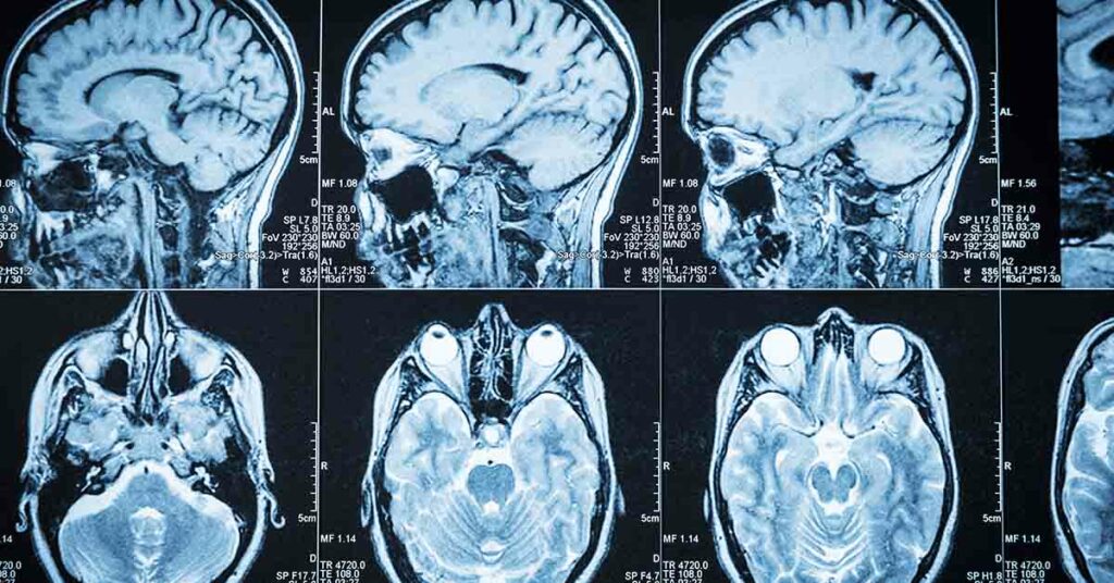 15 Things to Start Doing at 50 To Help Save Your Brain at 80 - Featured image