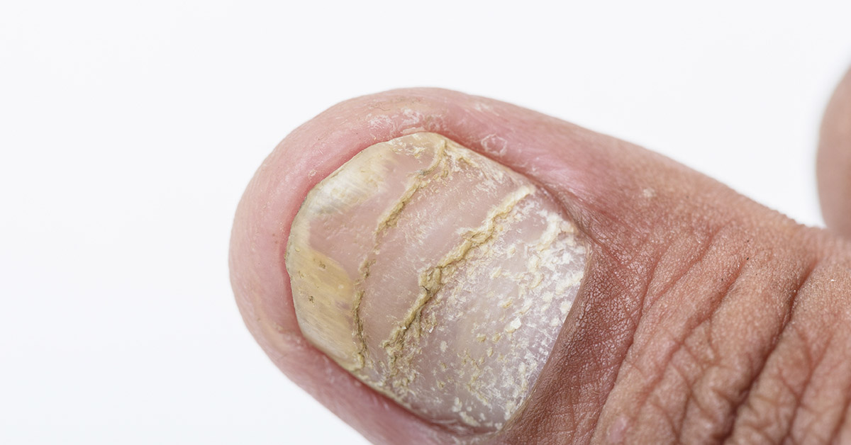 Unhealthy fingernail