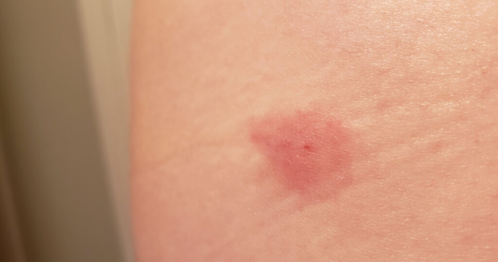 Insect bite on light colored skin pink irregular rash
