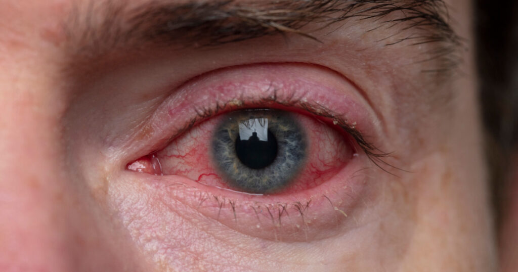 Close up of a severe bloodshot eye. Blepharitis, Conjunctivitis condition
