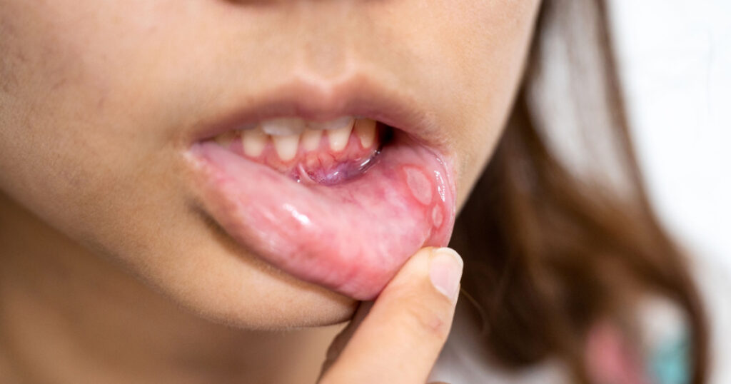 Close-up Asian woman have Aphthous ulcer or Canker sore on mouth at lip
